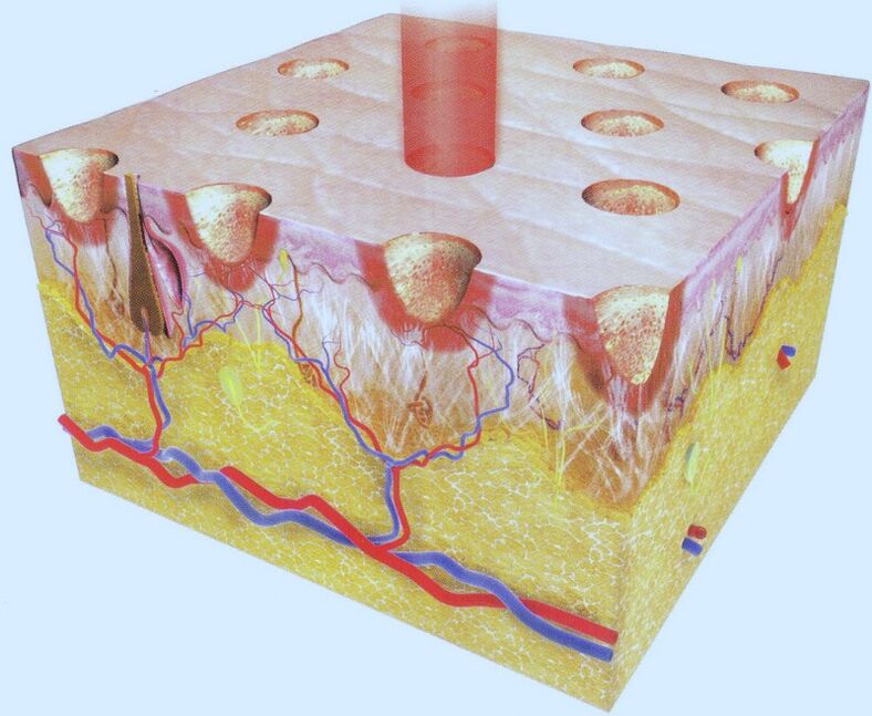 fractionele laser thermolyse