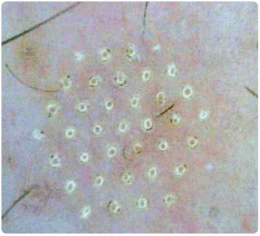 huid onder een microscoop na fractionele verjonging