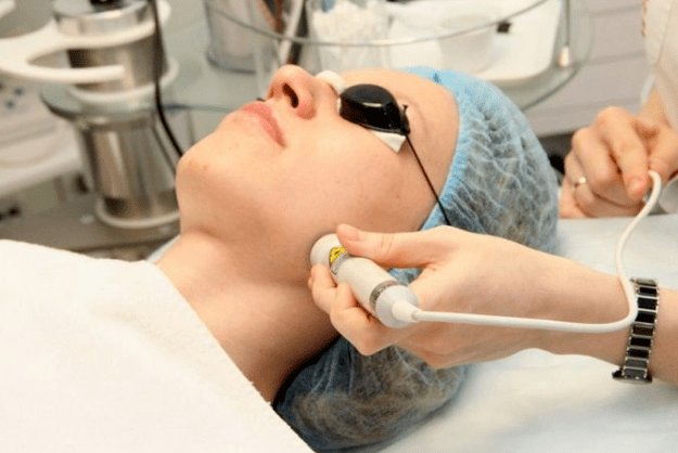 Laser biorevitalisatie